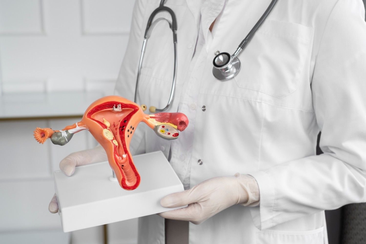 Best Pcos Treatment in Gurgaon