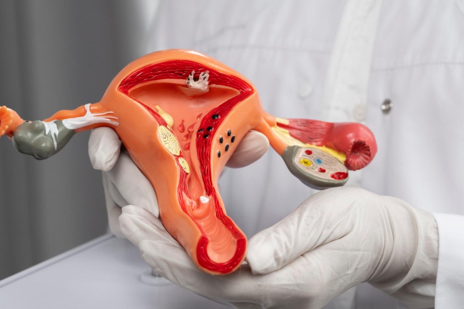Uterine Fibroid Treatment in Gurgaon